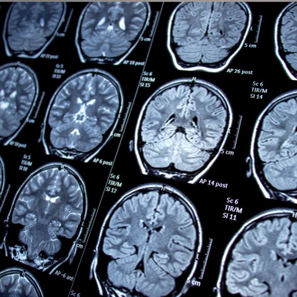 Understanding Epilepsy Level 2